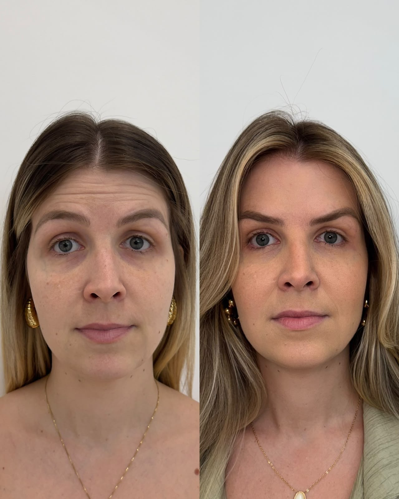Comparação clínica autorizada de expressão facial após toxina botulínica