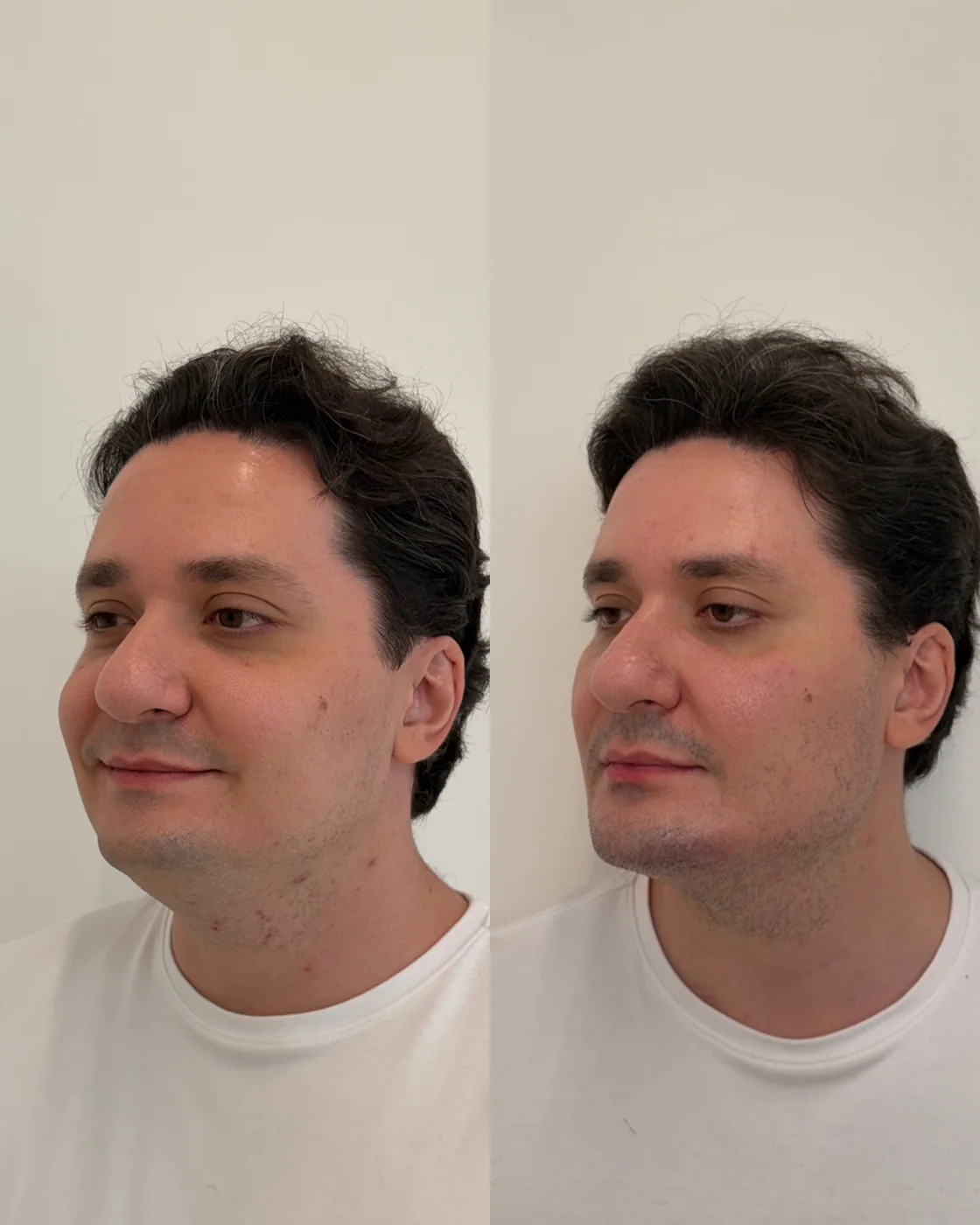 Antes e depois autorizado de harmonização facial para homens e mulheres realizado pela Dra. Lhuana — Harmonização Facial para Homens e Mulheres